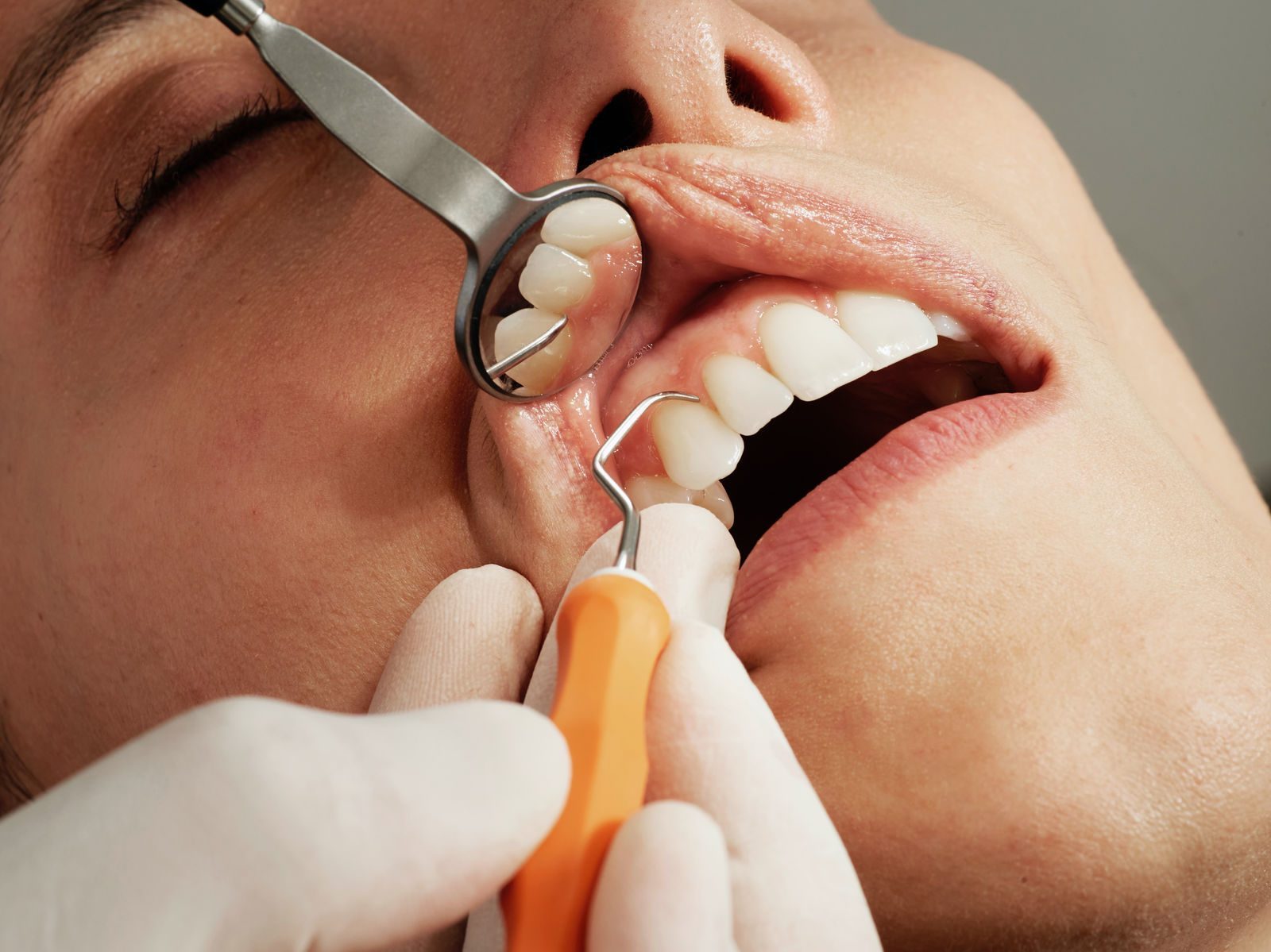 Democratizing Orthodontic Care with AI